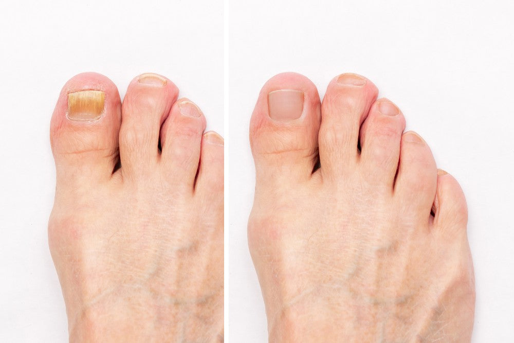 How To Find the Best Toenail Fungus Treatment for You!