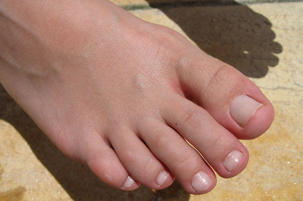 Nail Fungus Nightmare? Discover The Surprising Benefits of OTC Nail Fungus Treatments