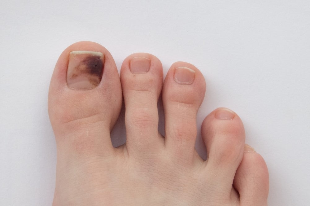 How to Deal With Toenail Discoloration: Easy Steps to Restore Healthy Nails