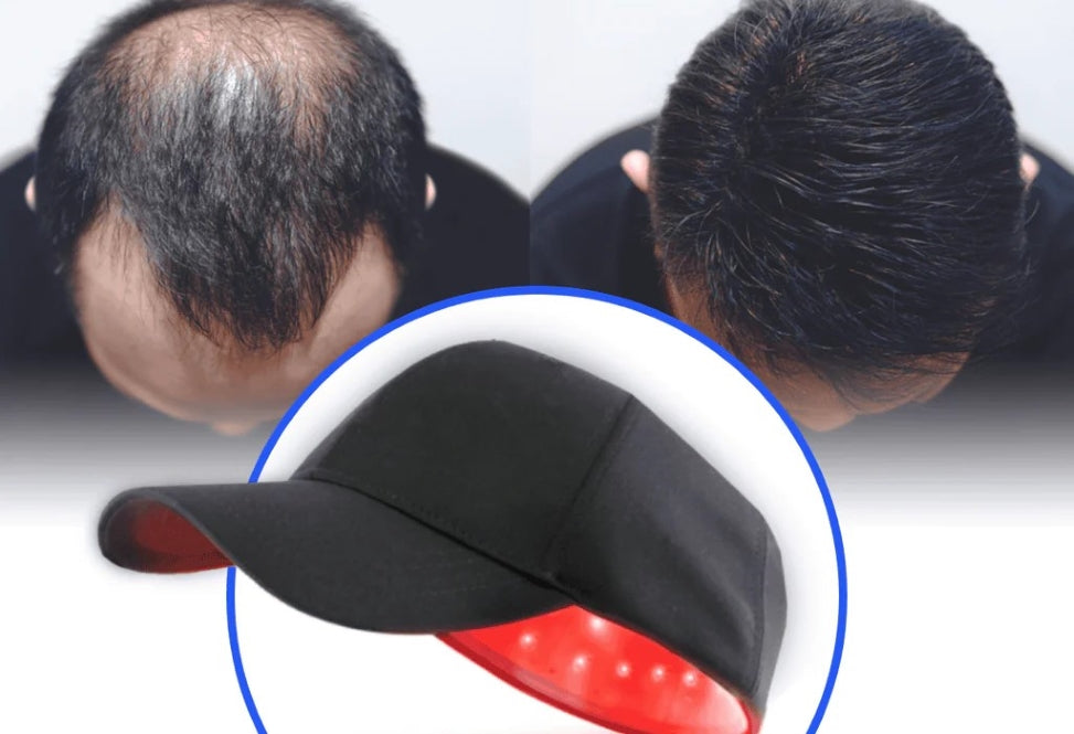 Can Laser Hair Caps Save Your Hair? Here’s What Science Says!