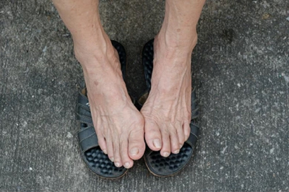 Top Nail Fungus Treatment Strategies Every Older Adult Should Know