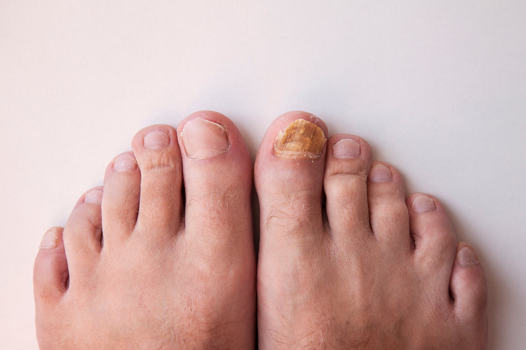 The Shocking Consequences of Having Untreated Toenail Fungus for Too Long