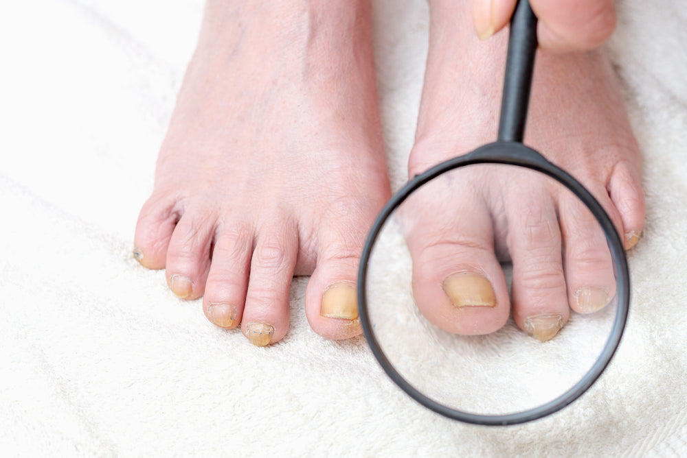 Toenail Fungus Myths Debunked: What Really Works?
