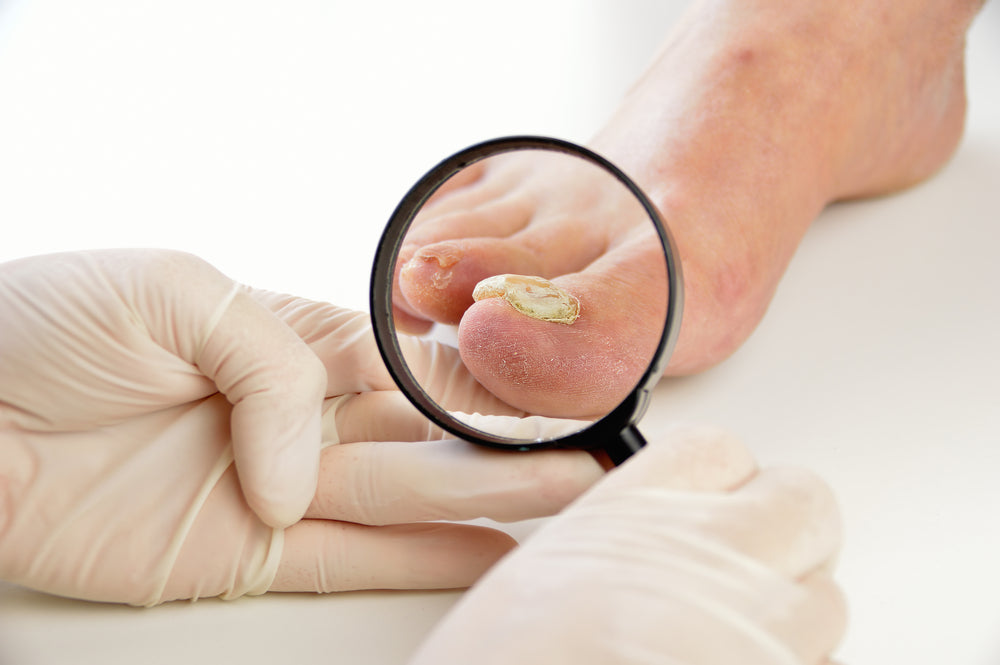 Toenail Fungus Treatment Failures: Why Some Methods Don’t Work and What to Do Instead