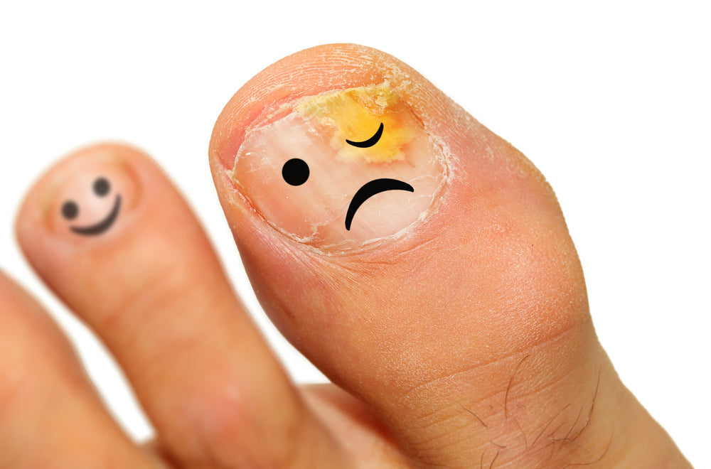 Is Your Toenail Fungus Treatment Failing? Here’s What You’re Doing Wrong