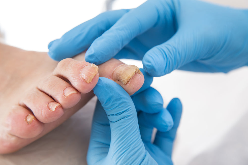 What Not to Do with Toenail Fungus: 11 Common Mistakes That Make It Worse