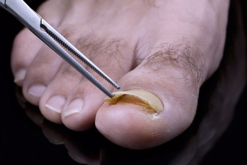 The Hidden Financial, Emotional, and Social Costs of Ignoring Toenail Fungus