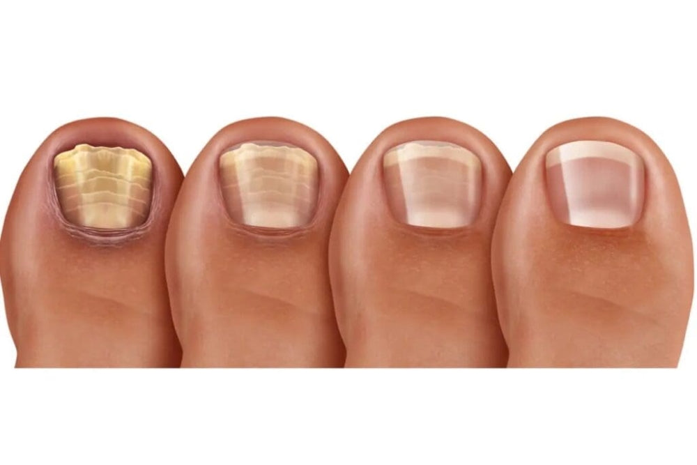 Why Ignoring Toenail Discoloration Could Wreck Your Nail Health