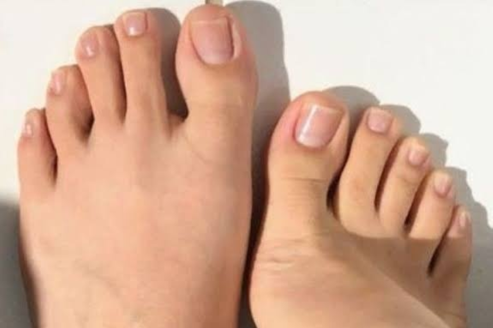 Can you combine different toenail fungus treatments? Find out here!