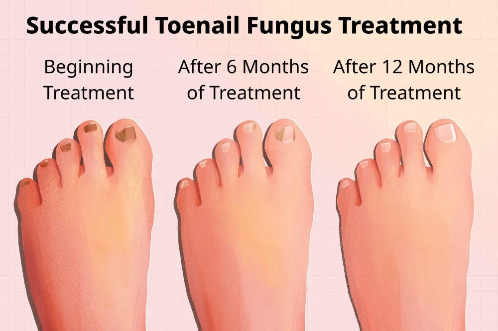 Your Countdown to Clear Nails: How Long Does Toenail Fungus Treatment Take?