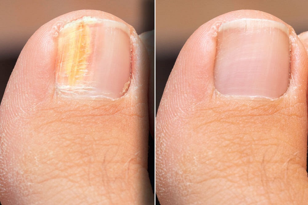 Discover How Topical Nail Fungus Treatments Banish Nail Fungus Infections for Good