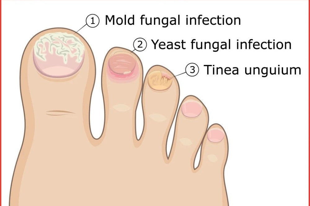 Do Toenail Fungus Types Matter? Why Tailored Toenail Fungus Treatments Are Key