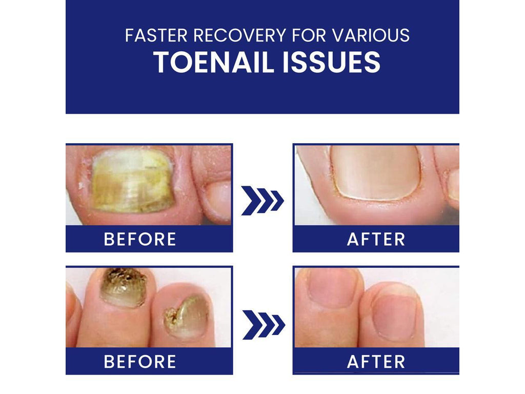 Nail Fungus Infection Treatment Singapore